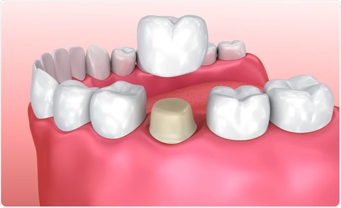 Dental Crown Implant